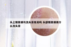 頭上銀屑病與洗頭膏有關(guān)嗎 頭部銀屑病用什么洗頭膏