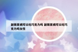 副銀屑病可以吃巧克力嗎 副銀屑病可以吃巧克力嗎女性