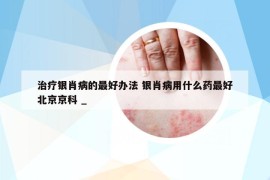治療銀肖病的最好辦法 銀肖病用什么藥最好北京京科 _
