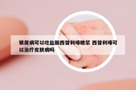 銀屑病可以吃鹽酸西替利嗪糖漿 西替利嗪可以治療皮膚病嗎