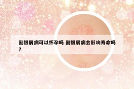 副銀屑病可以懷孕嗎 副銀屑病會影響壽命嗎?