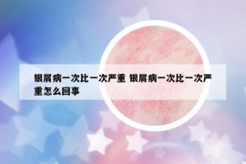 銀屑病一次比一次嚴重 銀屑病一次比一次嚴重怎么回事