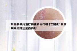 銀屑病中藥治療和西藥治療哪個效果好 銀屑病中藥好還是西藥好