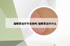 貓眼草治療牛皮癬嗎 貓眼草治療什么