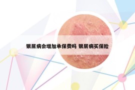 銀屑病會(huì)增加承保費(fèi)嗎 銀屑病買保險(xiǎn)