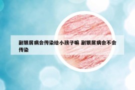 副銀屑病會傳染給小孩子嘛 副銀屑病會不會傳染