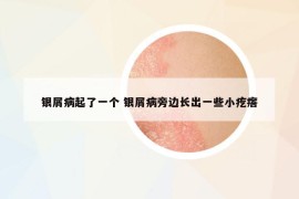 銀屑病起了一個(gè) 銀屑病旁邊長(zhǎng)出一些小疙瘩