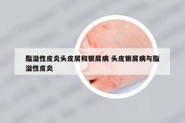 脂溢性皮炎頭皮屑和銀屑病 頭皮銀屑病與脂溢性皮炎