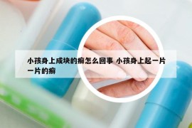 小孩身上成塊的癬怎么回事 小孩身上起一片一片的癬