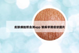 皮膚病拍照自測(cè)app 銀癬早期癥狀圖片