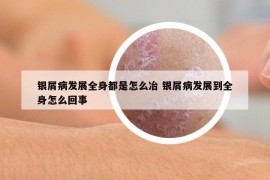 銀屑病發(fā)展全身都是怎么冶 銀屑病發(fā)展到全身怎么回事
