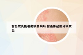 智齒發(fā)炎能引出銀屑病嗎 智齒影起的牙銀發(fā)炎