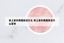 身上老長癬是缺乏什么 身上老長癬是缺乏什么營養(yǎng)
