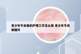 青少年牛皮癬的護理工作怎么做 青少年牛皮癬圖片