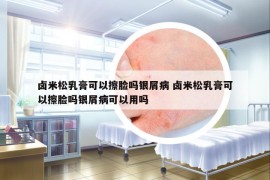 鹵米松乳膏可以擦臉嗎銀屑病 鹵米松乳膏可以擦臉嗎銀屑病可以用嗎