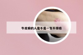 牛皮癬的人是不是一生不得癌