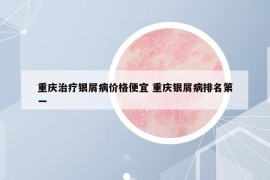 重慶治療銀屑病價(jià)格便宜 重慶銀屑病排名第一