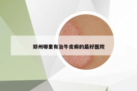 鄭州哪里有治牛皮癬的最好醫(yī)院