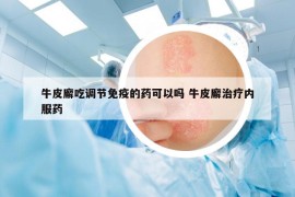 牛皮廨吃調(diào)節(jié)免疫的藥可以嗎 牛皮廨治療內(nèi)服藥