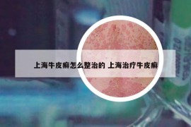 上海牛皮癬怎么整治的 上海治療牛皮癬