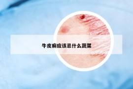 牛皮癬應(yīng)該忌什么蔬菜