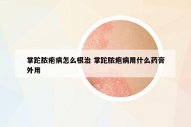 掌跎膿皰病怎么根治 掌跎膿皰病用什么藥膏外用