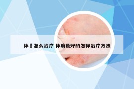 體廯怎么治療 體癬最好的怎樣治療方法