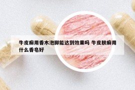 牛皮癬用香木泡腳能達(dá)到效果嗎 牛皮膚癬用什么香皂好