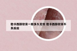 他卡西醇軟膏一般多久見效 他卡西醇軟膏不良反應(yīng)