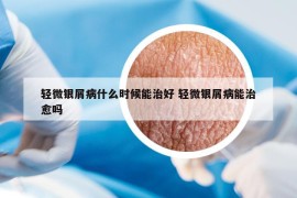 輕微銀屑病什么時候能治好 輕微銀屑病能治愈嗎