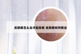 皮膚癬怎么治才能除根 皮膚癬如何根治