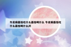 牛皮癬最怕吃什么最怕喝什么 牛皮癬最怕吃什么最怕喝什么藥