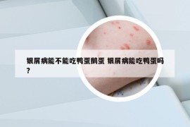 銀屑病能不能吃鴨蛋鵝蛋 銀屑病能吃鴨蛋嗎?