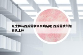 凡士林與西瓜霜制銀屑病貼吧 西瓜霜噴劑加白凡士林
