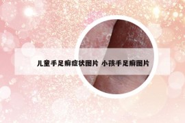 兒童手足癬癥狀圖片 小孩手足癬圖片