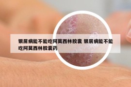 銀屑病能不能吃阿莫西林膠囊 銀屑病能不能吃阿莫西林膠囊藥