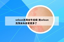 selsun洗發(fā)水牛皮癬 用selsun洗發(fā)水頭皮屑更多了