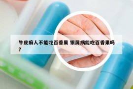 牛皮癬人不能吃百香果 銀屑病能吃百香果嗎?