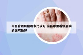 南昌看銀屑病哪家比較好 南昌哪里看銀屑病的醫(yī)院最好