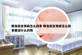 眼角脫皮像癬怎么回事 眼角脫皮像癬怎么回事要涂什么藥物