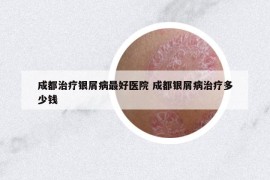 成都治療銀屑病最好醫(yī)院 成都銀屑病治療多少錢