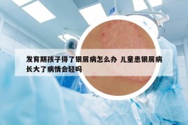 發(fā)育期孩子得了銀屑病怎么辦 兒童患銀屑病長大了病情會(huì)輕嗎