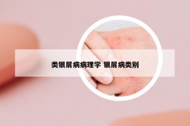 類銀屑病病理學(xué) 銀屑病類別
