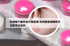 杭州哪個醫(yī)院治療銀屑病 杭州銀屑病哪種方法能可以治好