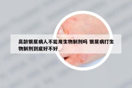 高齡銀屑病人不能用生物制劑嗎 銀屑病打生物制劑到底好不好