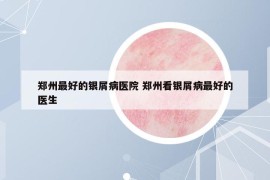 鄭州最好的銀屑病醫(yī)院 鄭州看銀屑病最好的醫(yī)生