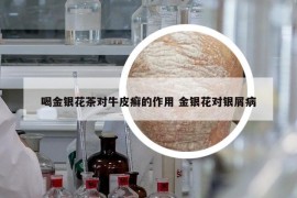 喝金銀花茶對牛皮癬的作用 金銀花對銀屑病