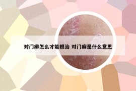 對(duì)門癬怎么才能根治 對(duì)門癬是什么意思