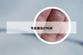 牛皮癬治療時間