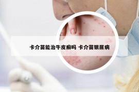 卡介苗能治牛皮癬嗎 卡介苗銀屑病